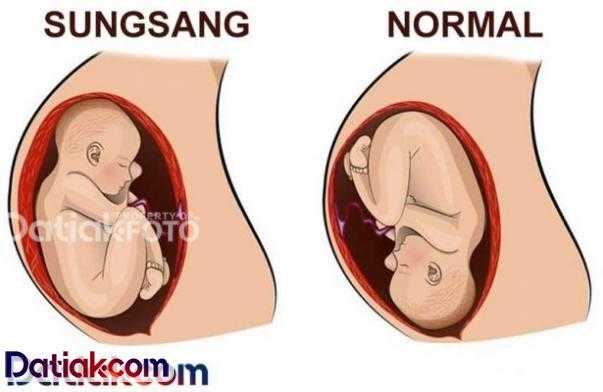Ilustrasi posisi janin saat hamil sungsang. (Gambar Datiak.com)