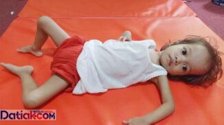 Shakira Putri Ananda, balita penderita jantung bocor di Padangpariaman